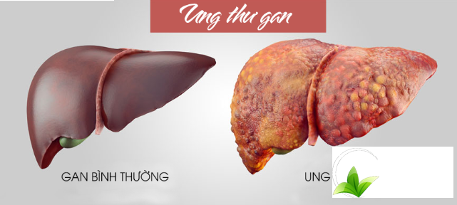 ho-tro-dieu-tri-benh-ung-thu-gan