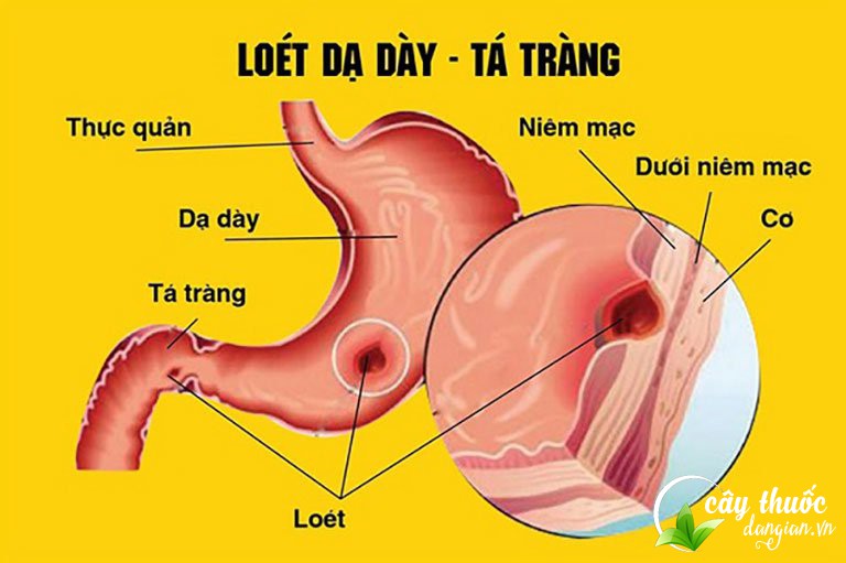 cam-thao-ho-tro-dieu-tri-viem-loet-da-day