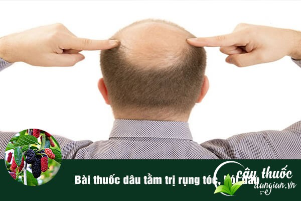 Dâu tằm giúp trị rụng tóc, hói đầu.