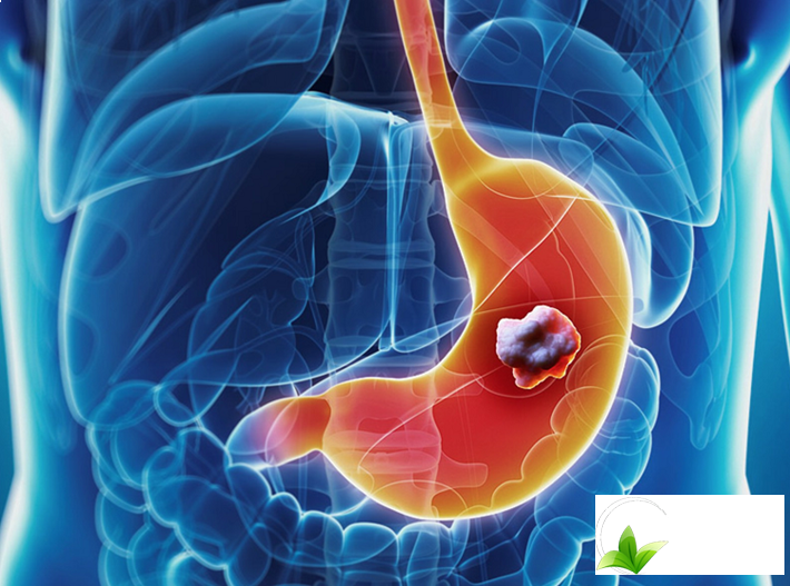 ho-tro-dieu-tri-ung-thu-da-day