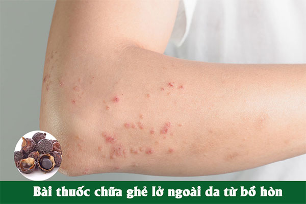 Bài thuốc bồ hòn chữa ghẻ và lở loét ngoài da được nhiều người áp dụng.