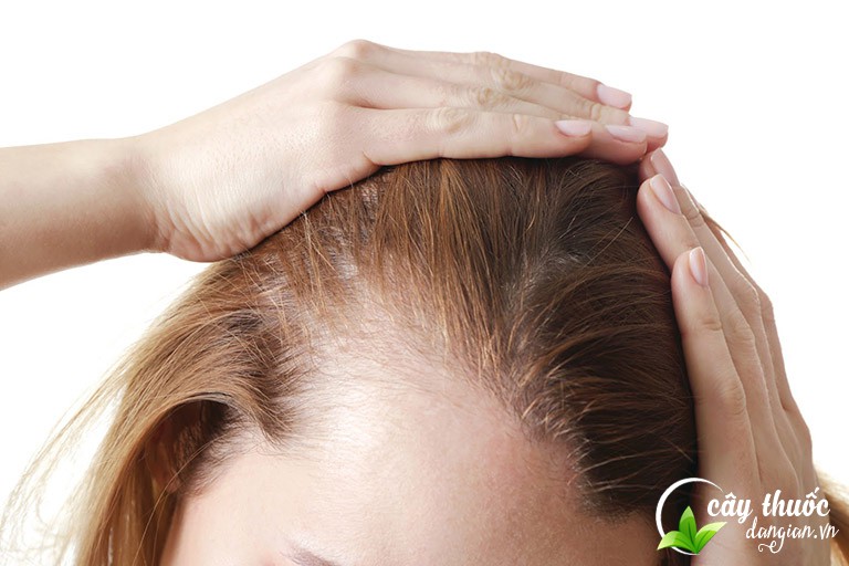 ho-tro-dieu-tri-gau-chung-rung-toc