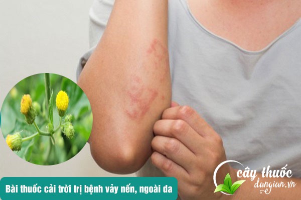 Bài thuốc cải trời chữa bệnh vảy nến