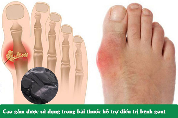 Cao gắm thường được dùng trong các bài thuốc Đông y hỗ trợ điều trị bệnh gout