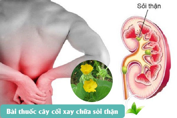 Bài thuốc chữa sỏi thận từ cây cối xay được nhiều người bệnh áp dụng