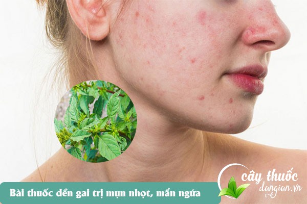 Bài thuốc dền gai trị mụn, mẩn ngứa di ứng rất tốt