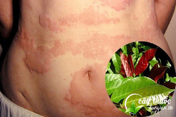 Bài thuốc cây đơn tướng quân trị viêm da cơ địa, mẩn ngứa