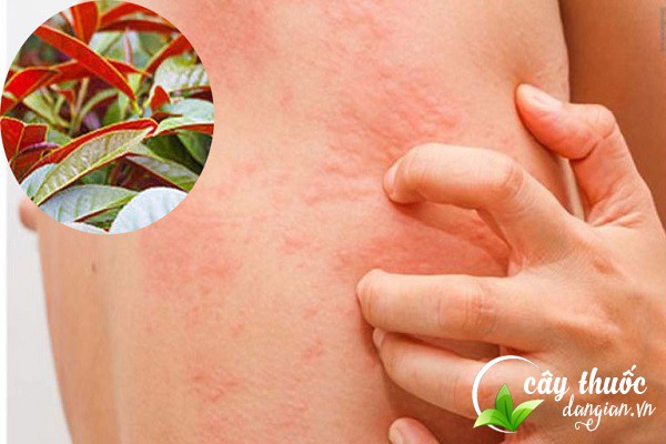 Cây đơn đỏ được biết đến có tác dụng chữa trị mẩn ngứa, mề đay