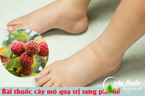 Bài thuốc mỏ quạ trị chứng phù nề