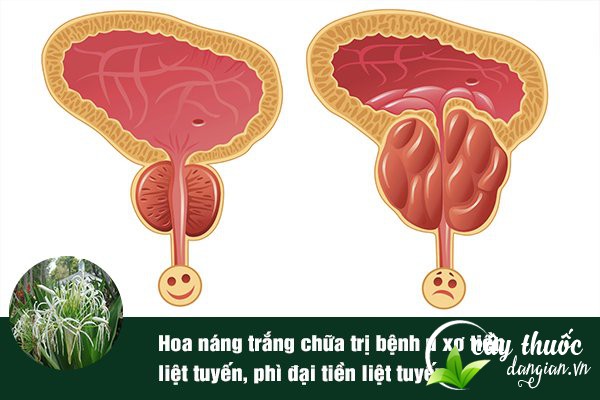 Bài thuốc hoa náng trắng chữa u xơ (phì đại) tuyến tiền liệt cho nam giới rất tốt.