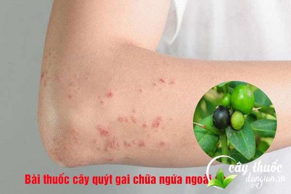 Bài thuốc cây quýt gai chữa mẩn ngứa ngoài da