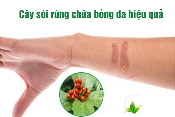Bài thuốc cây sói rừng chữa bỏng da hiệu quả
