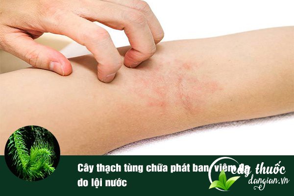 Bài thuốc cây thạch tùng giúp chữa phát ban, viêm da khá tốt.