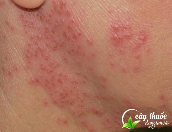 ho-tro-dieu-tri-benh-ngoai-da