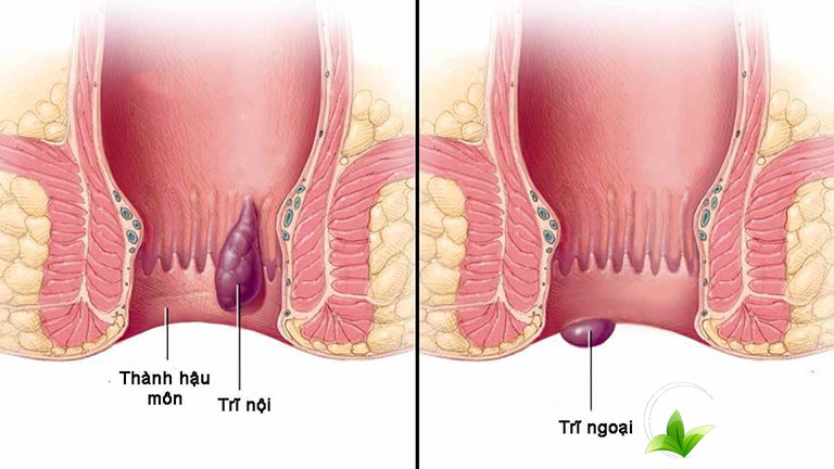 ho-tro-dieu-tri-benh-tri