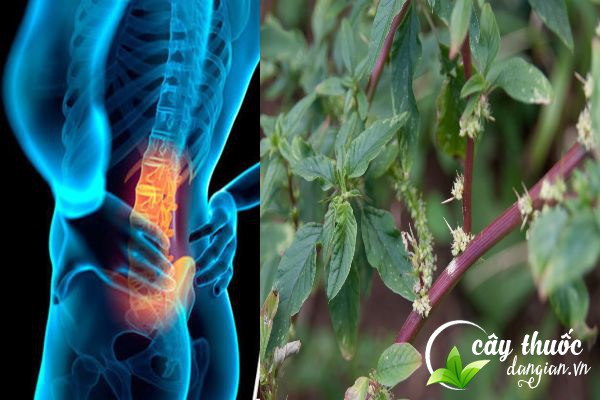 Bài thuốc dền gai chữa gai cột sống được nhiều bệnh nhân áp dụng