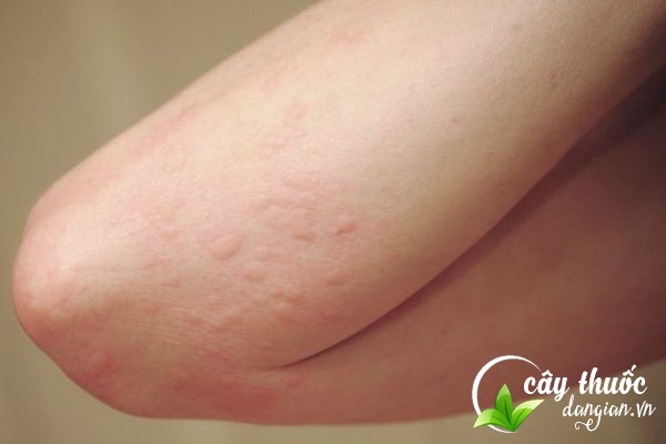 Ké đầu ngựa chữa ngứa do nhiều yếu tố