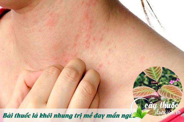 Bài thuốc khôi nhung trị mẩn ngứa, nổi mề đay