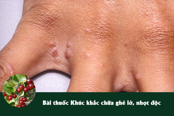 Khúc khắc thường được dùng trong bài thuốc chữa ghẻ lở, nhọt độc