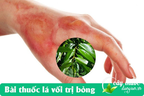 Lá vối sử dụng làm bài thuốc chữa bỏng rất tốt và hiệu quả tức thì.