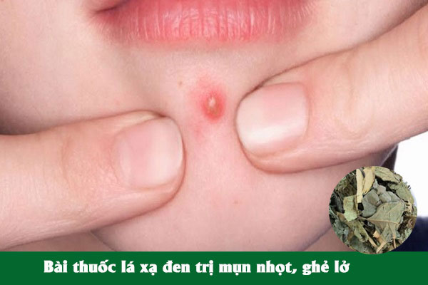 Bài thuốc lá xạ đen trị mụn nhọt, ghẻ lở