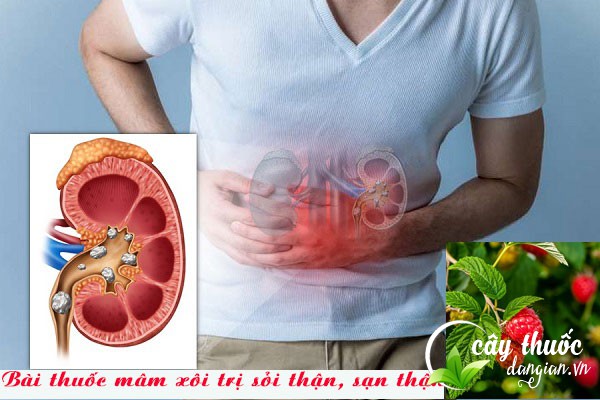 Bài thuốc mâm xôi trị sỏi thận, sạn thận vô cùng tốt