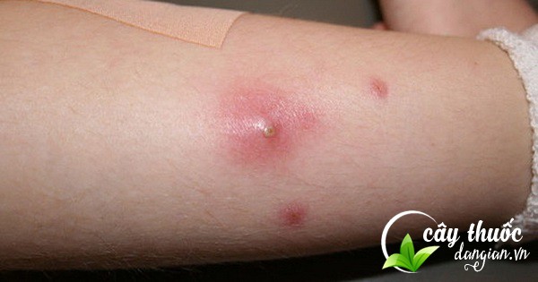 giam-sung-dau-do-ung-nhot