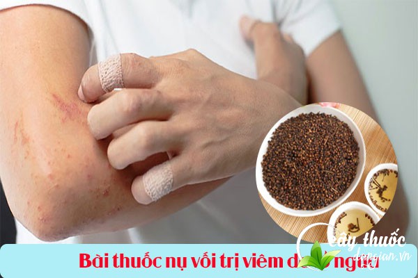 Bài thuốc từ nụ vối giúp chữa viêm da, lở ngứa