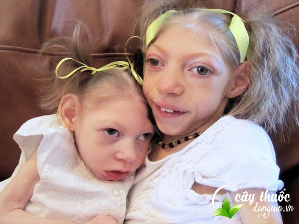 tim-hieu-ve-benh-te-nao