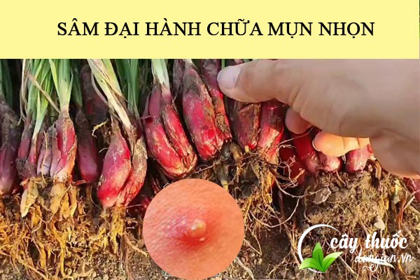 Bài thuốc sâm đại hành chữa mụn nhọt hiệu quả