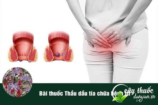 Thầu dầu tía thường được dùng để làm bài thuốc chữa bệnh trĩ rất hiệu quả.