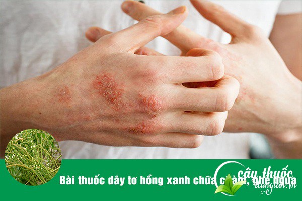 Bài thuốc tơ hồng xanh chữa chàm, ghẻ ngứa ngoài da rất tốt