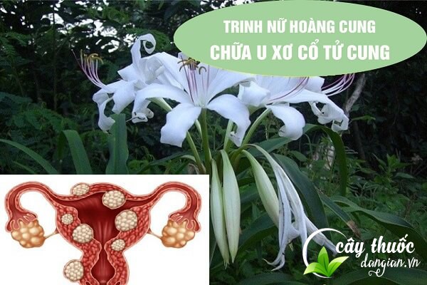 Bài thuốc trinh nữ hoàng cung chữa bệnh u xơ tử cung