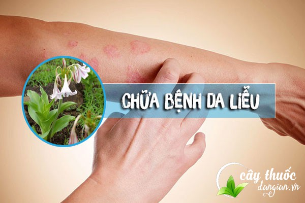 Bài thuốc trinh nữ hoàng cung trị mụn nhọt, bệnh da liễu