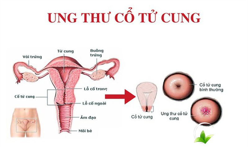 ho-tro-dieu-tri-ung-thu-co-tu-cung