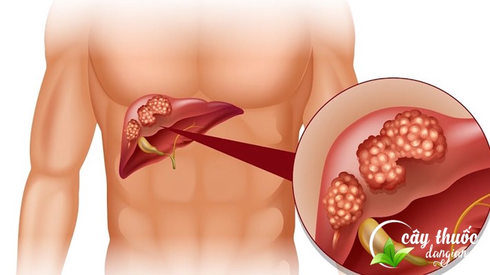 ho-tro-dieu-tri-benh-viem-gan-xo-gan